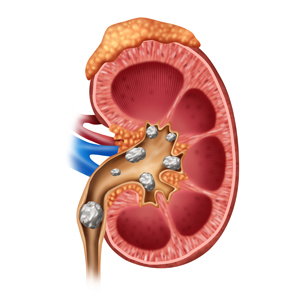 Kidney Stones